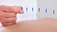 Acupuncture Therapy