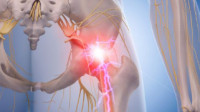 Sciatica Treatment